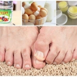 Funding gljivice na nogama sa sirćetom i jajetom