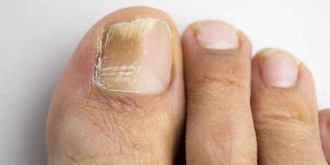 Liječenje gljivica za nokte sa jabukom sirćetom