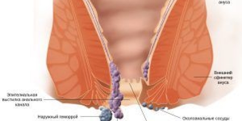 Posljedice upotrebe alkohola sa hemoroidima