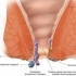 Posljedice upotrebe alkohola sa hemoroidima